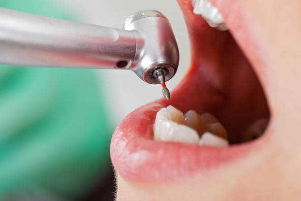 Best Dentist for Tooth Abscess  in Wellington, OH